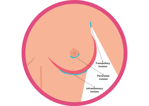 Breast Augmentation Technique Showcasing Transaxillary, Periareolar, And Inframammary Incisions By Beverly Hills Expert, Dr. Sheila Nazarian.