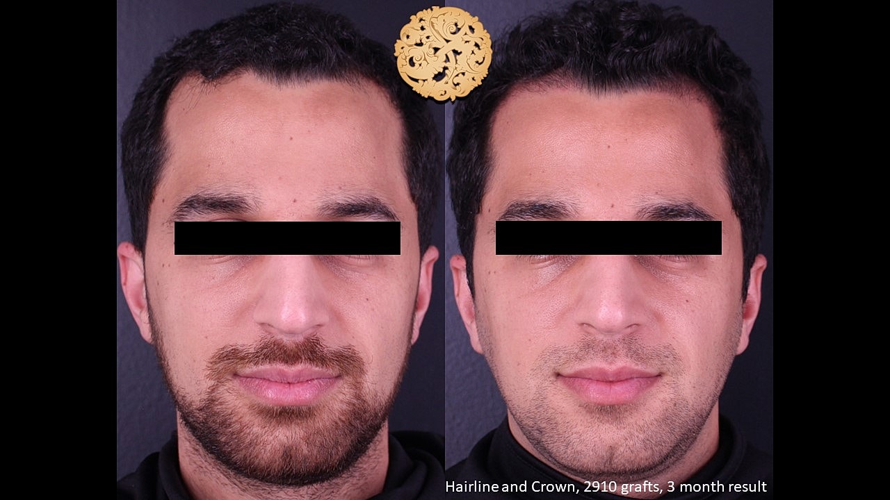 Hair restoration results after one month.