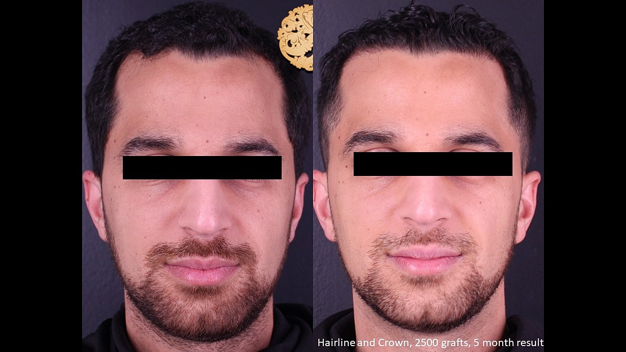 Hair restoration results after one month.