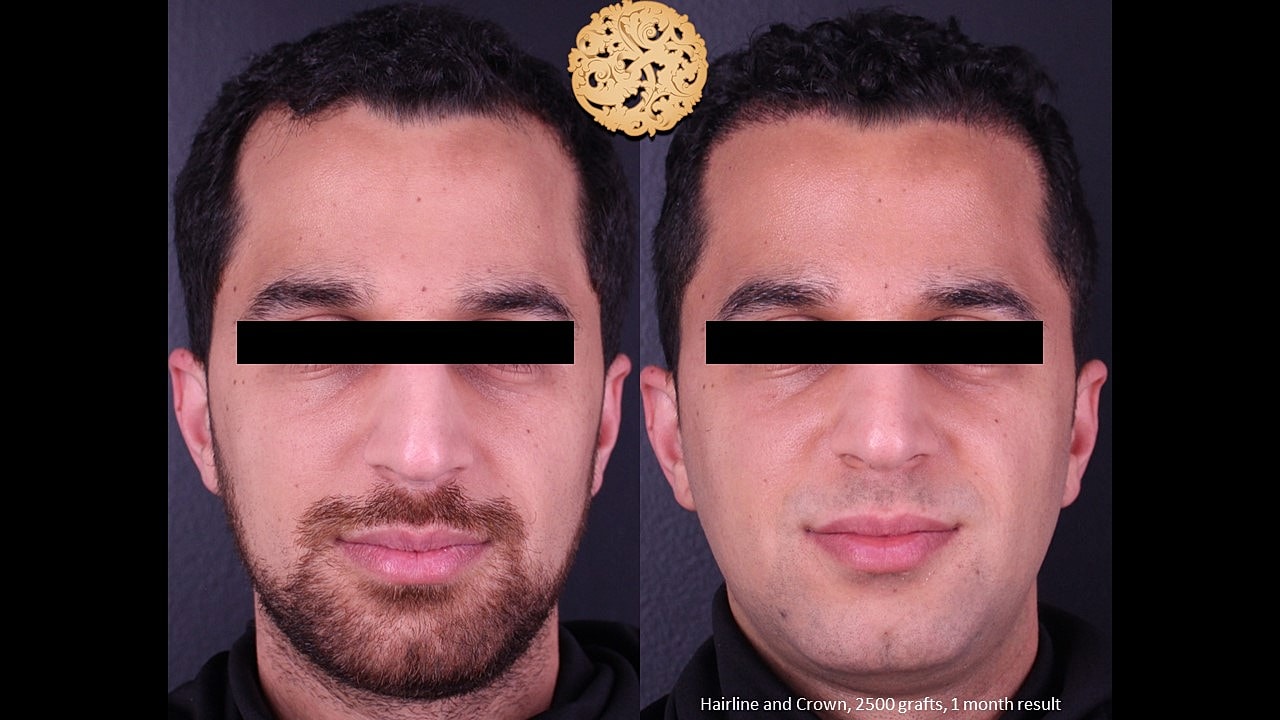 Hair restoration results after one month.