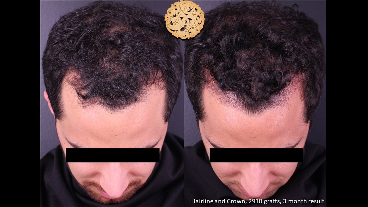 Hair transplant results before and after one month.