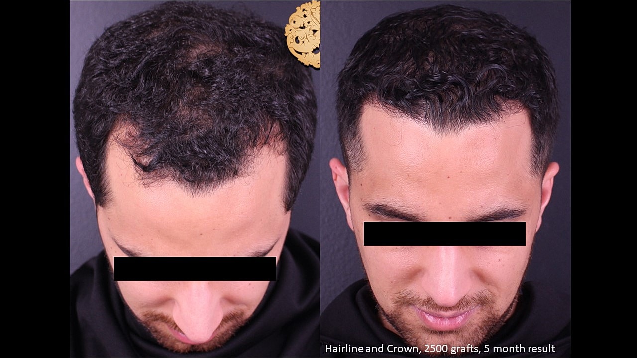 Hair transplant results before and after one month.