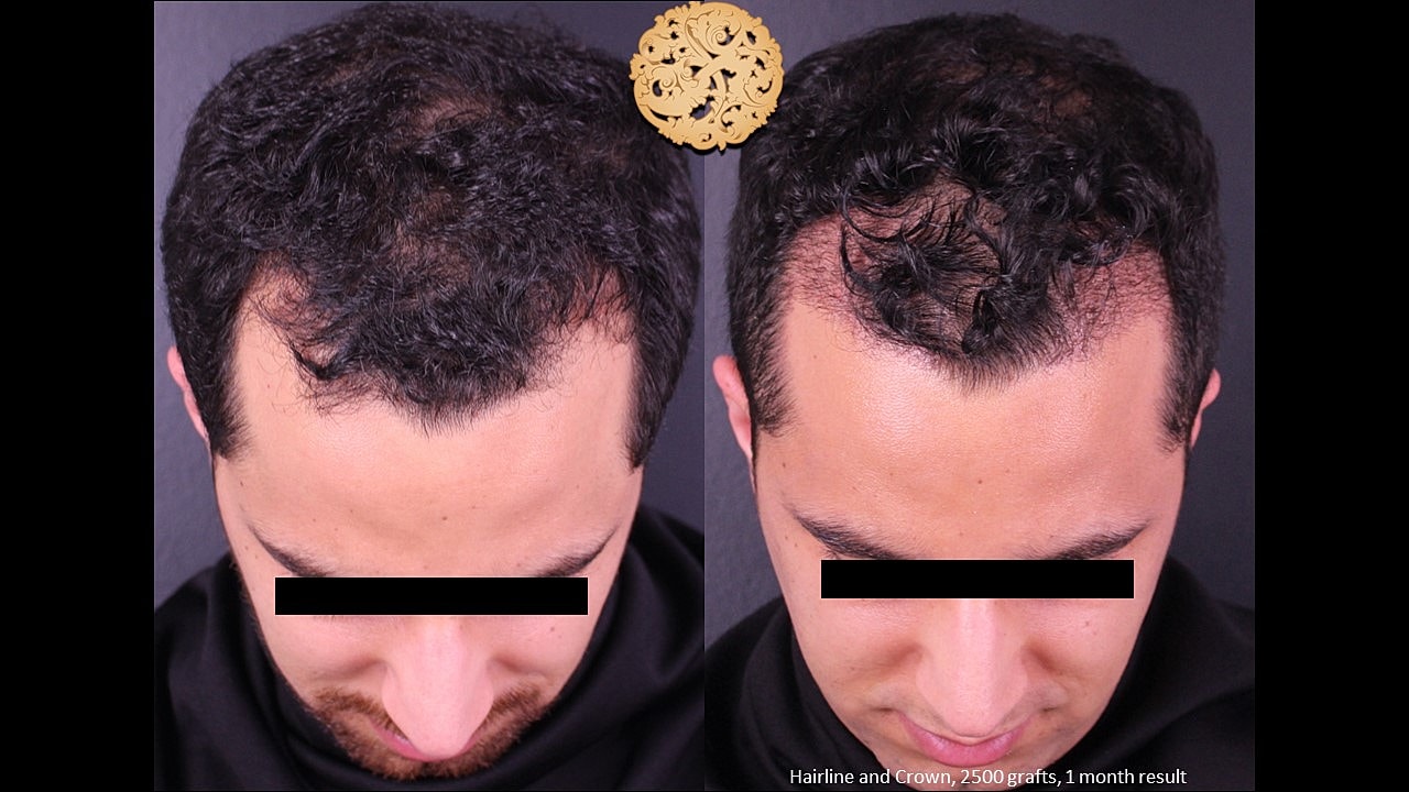 Hair transplant results before and after one month.