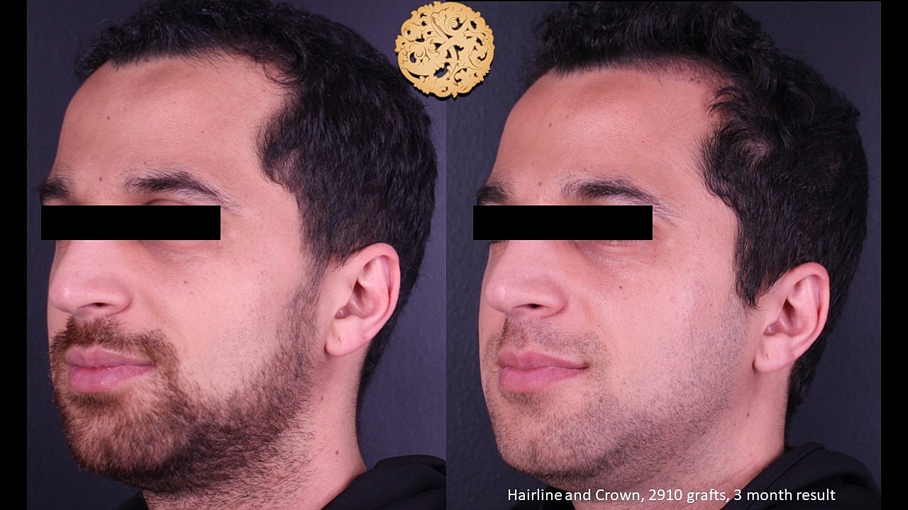 Before and after hair restoration comparison.