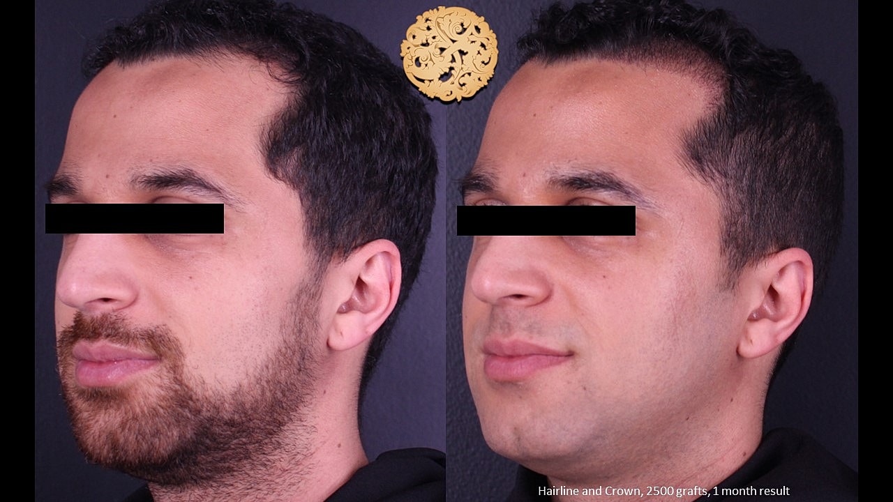 Before and after hair restoration comparison.