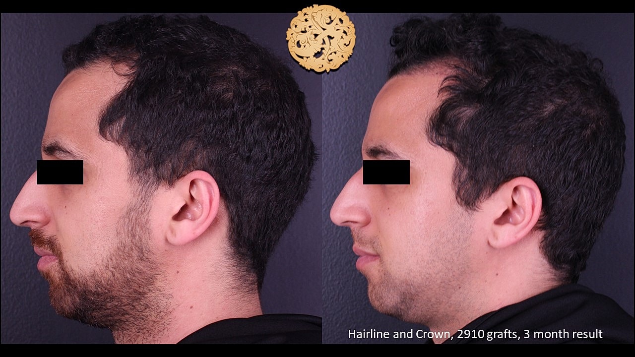 Before and after hair transplant results at three months.