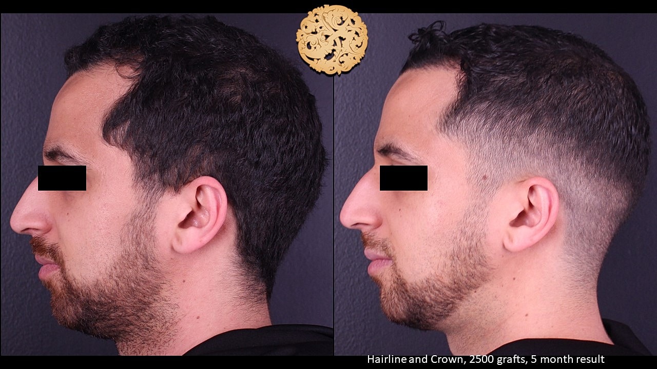 Before and after hair transplant results at three months.