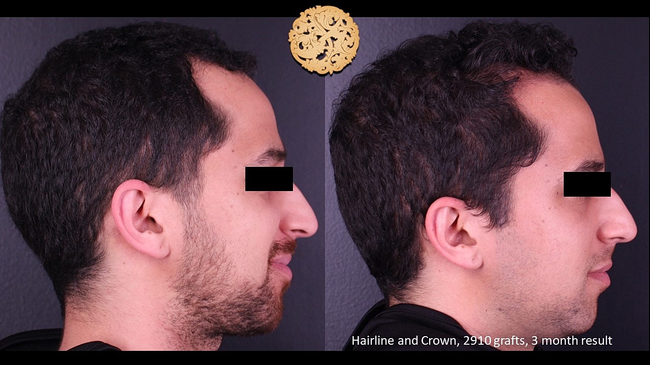Before and after hair transplant progress results.