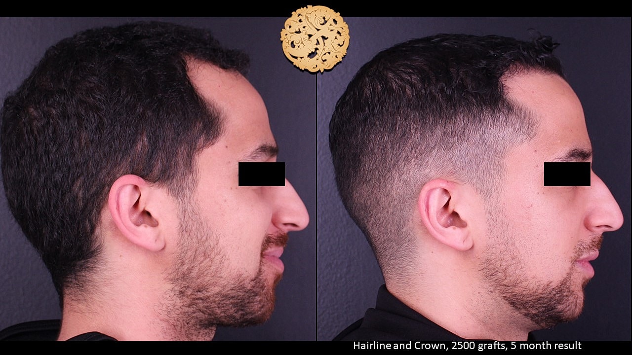 Before and after hair transplant progress results.