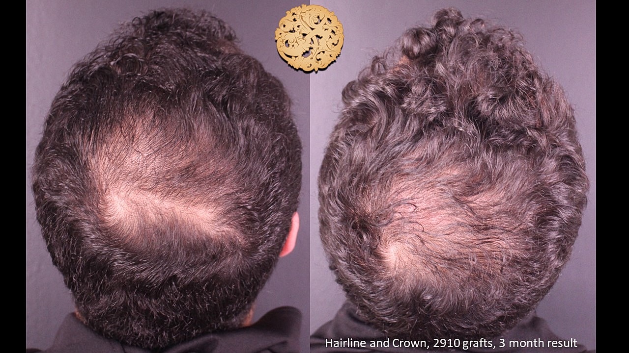 Before and after hair transplant progress results.