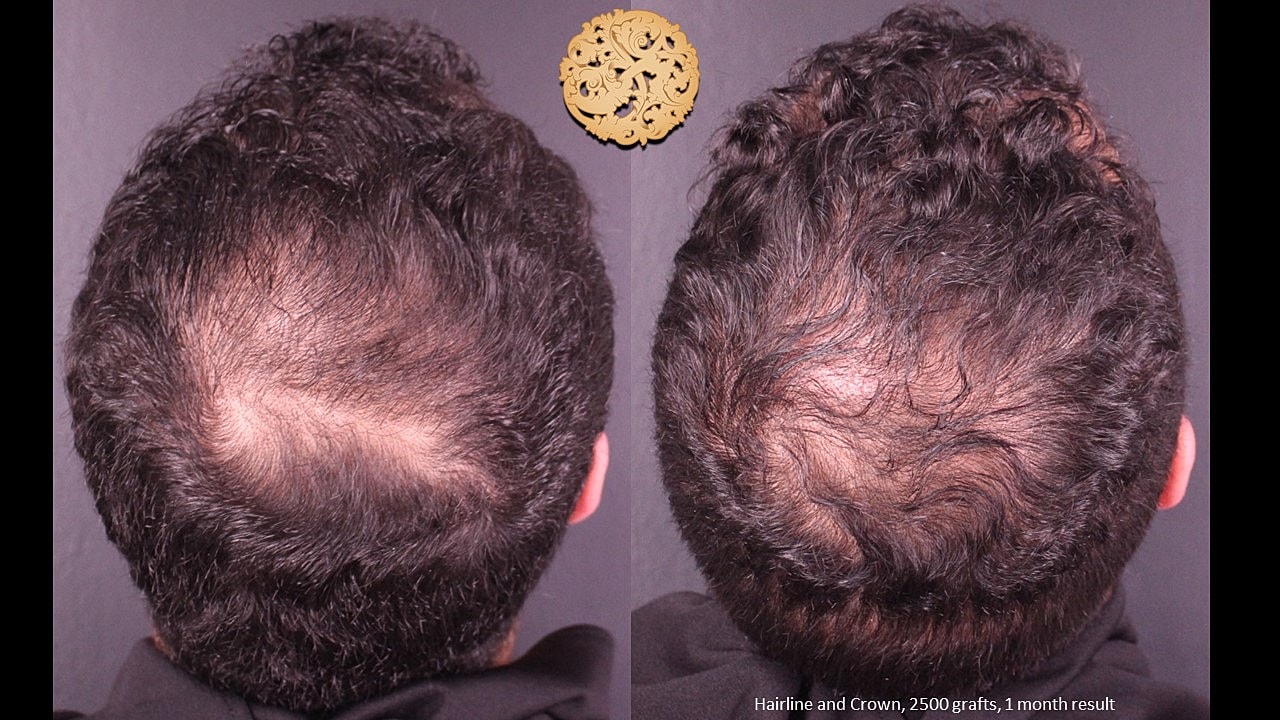 Before and after hair transplant progress results.