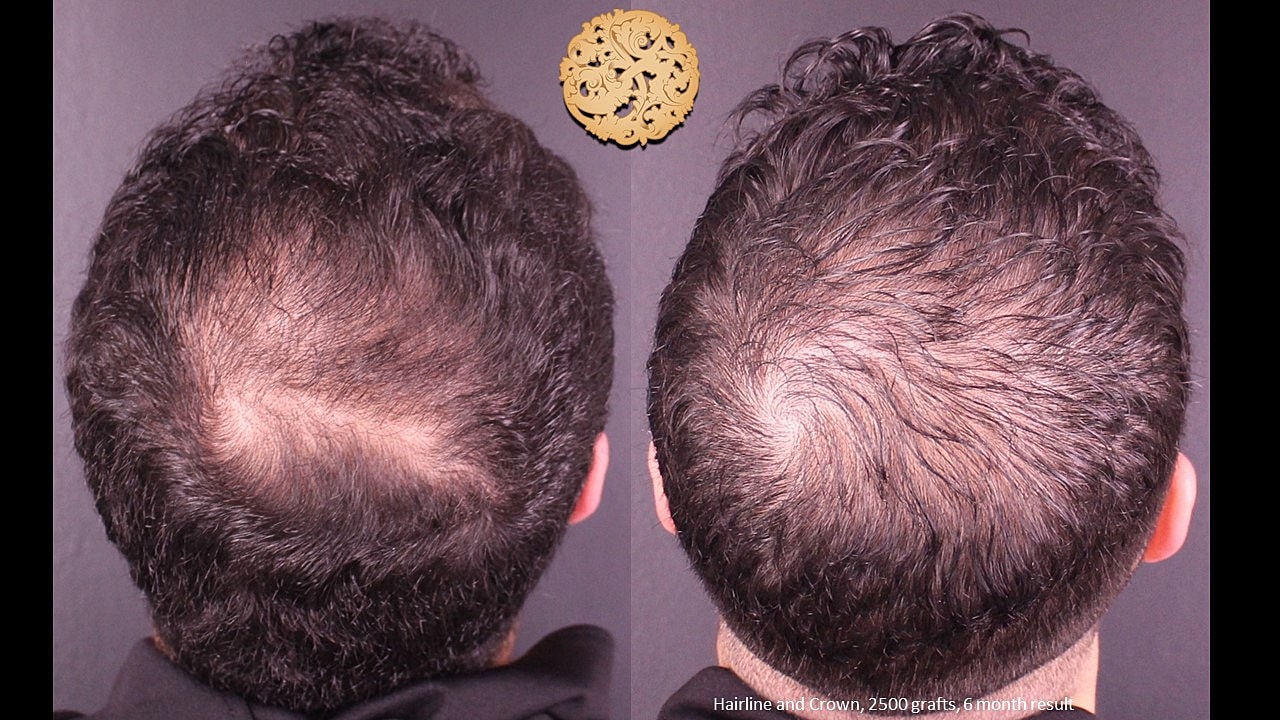 Before and after hair transplant progress results.