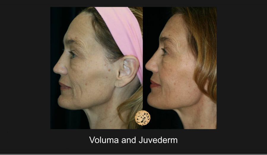 Temple Fillers Before & After