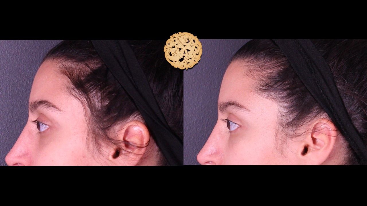 Temple Fillers Before & After