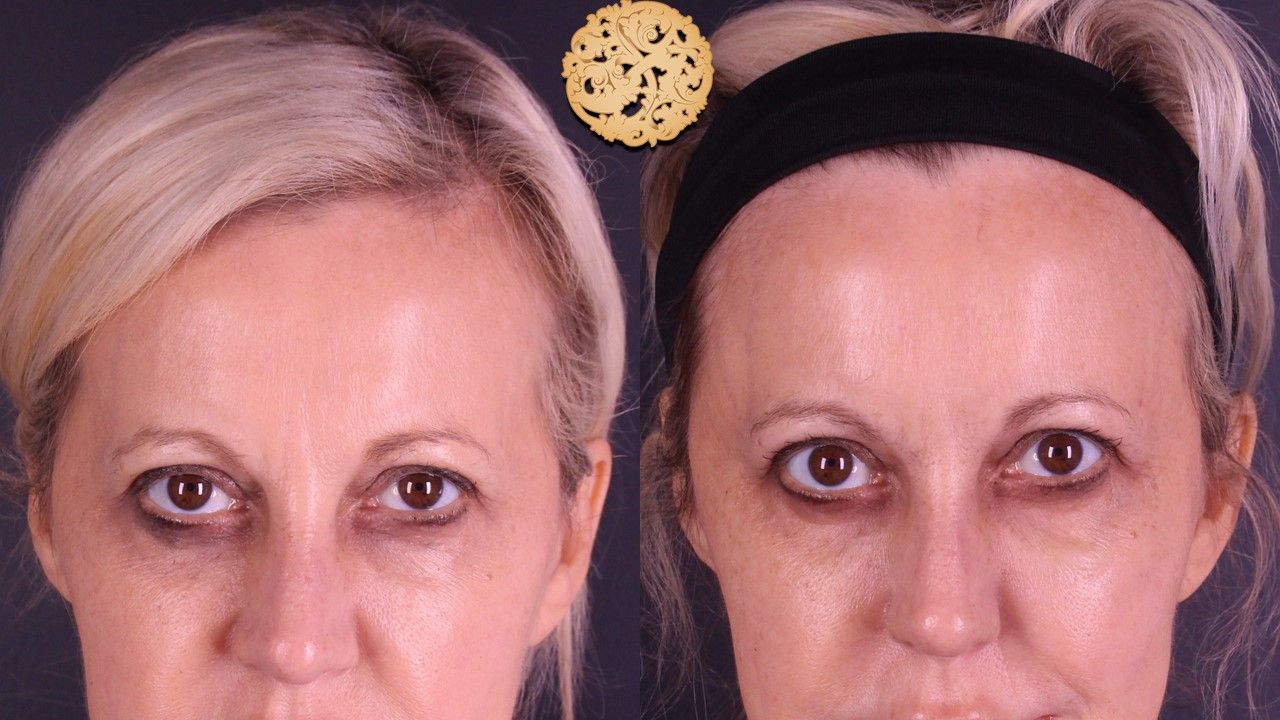 Temple Fillers Before & After