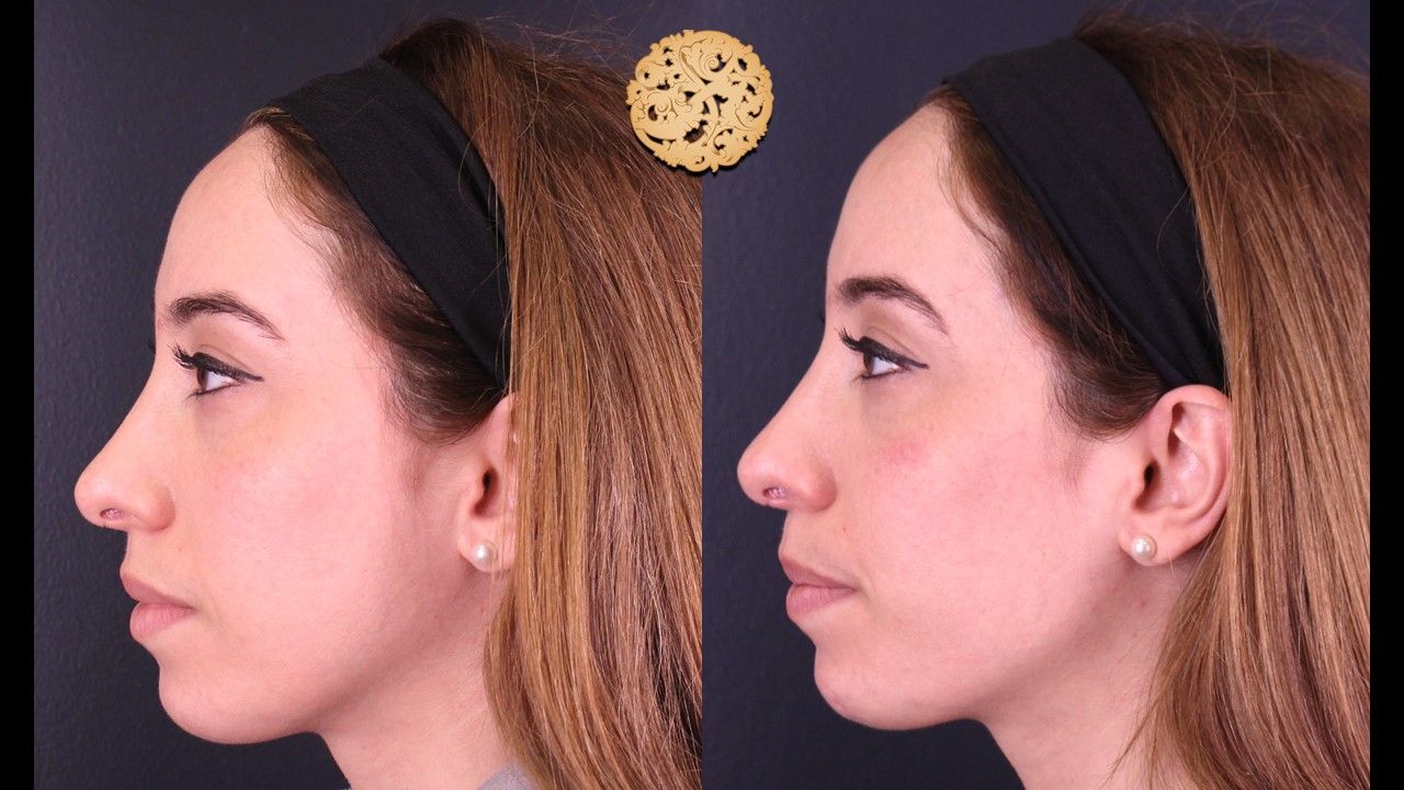 Temple Fillers Before & After