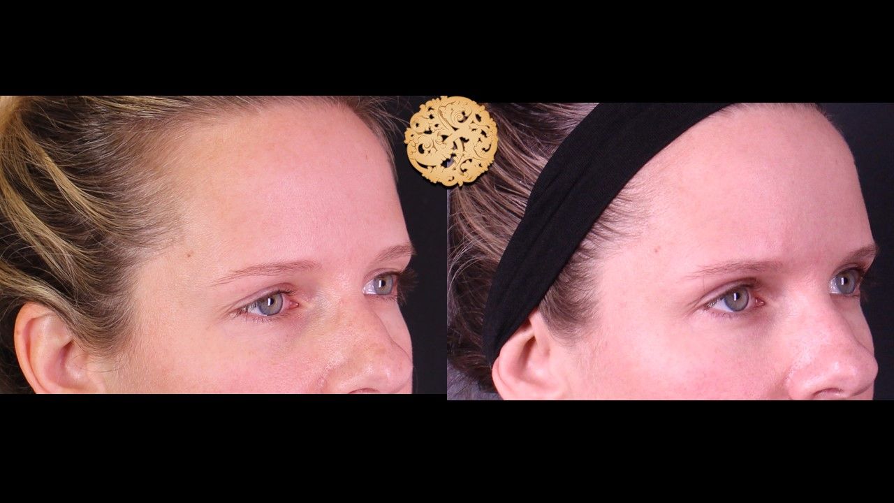 Temple Fillers Before & After