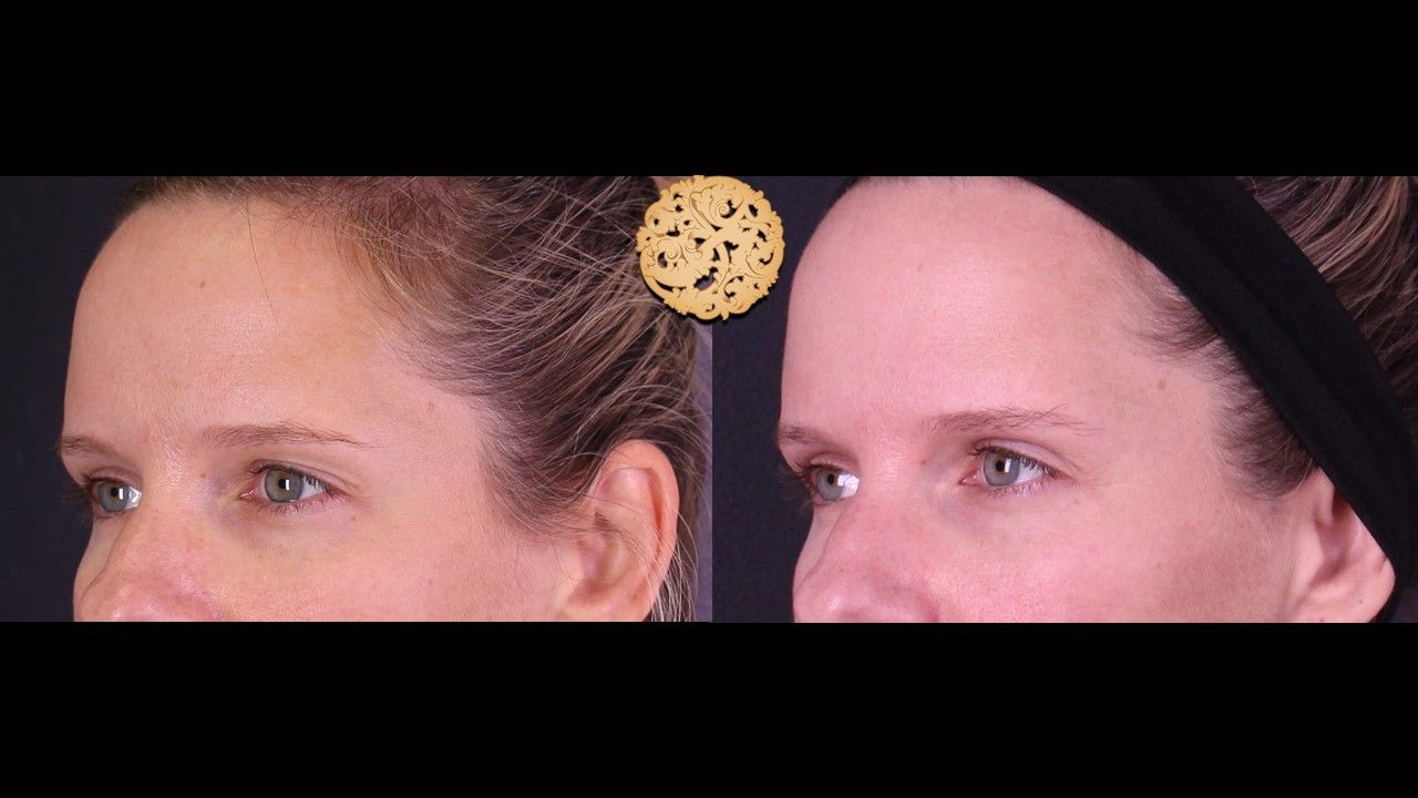 Temple Fillers Before & After