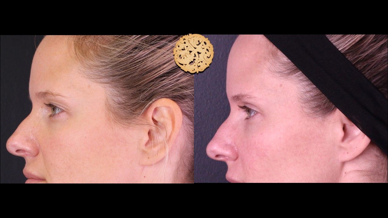 Temple Fillers Before & After