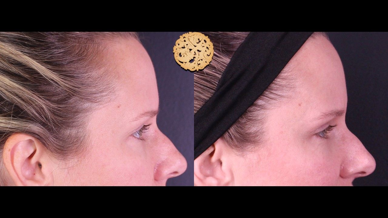 Temple Fillers Before & After