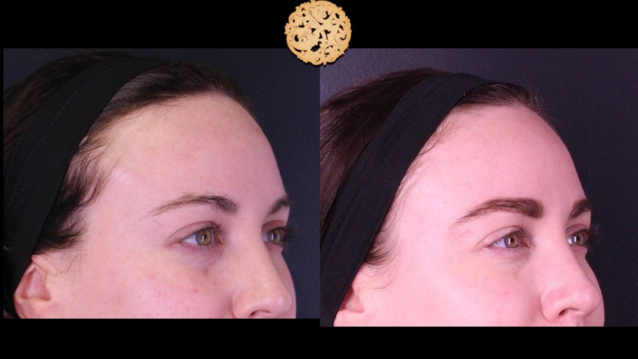 Temple Fillers Before & After