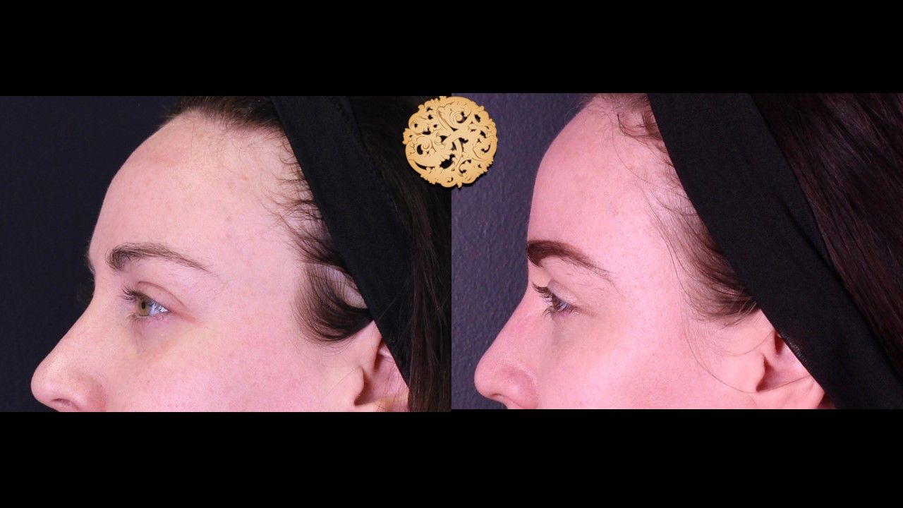 Temple Fillers Before & After