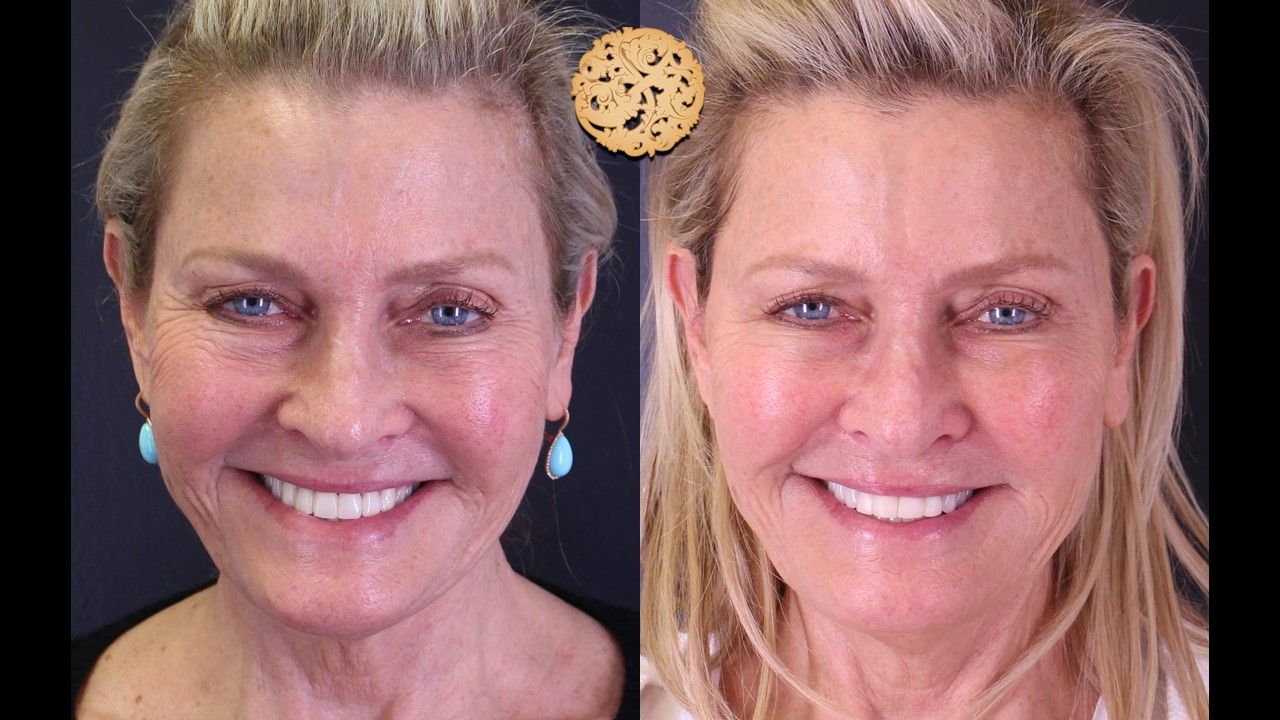 Temple Fillers Before & After