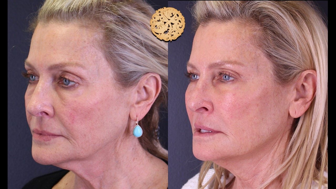 Temple Fillers Before & After