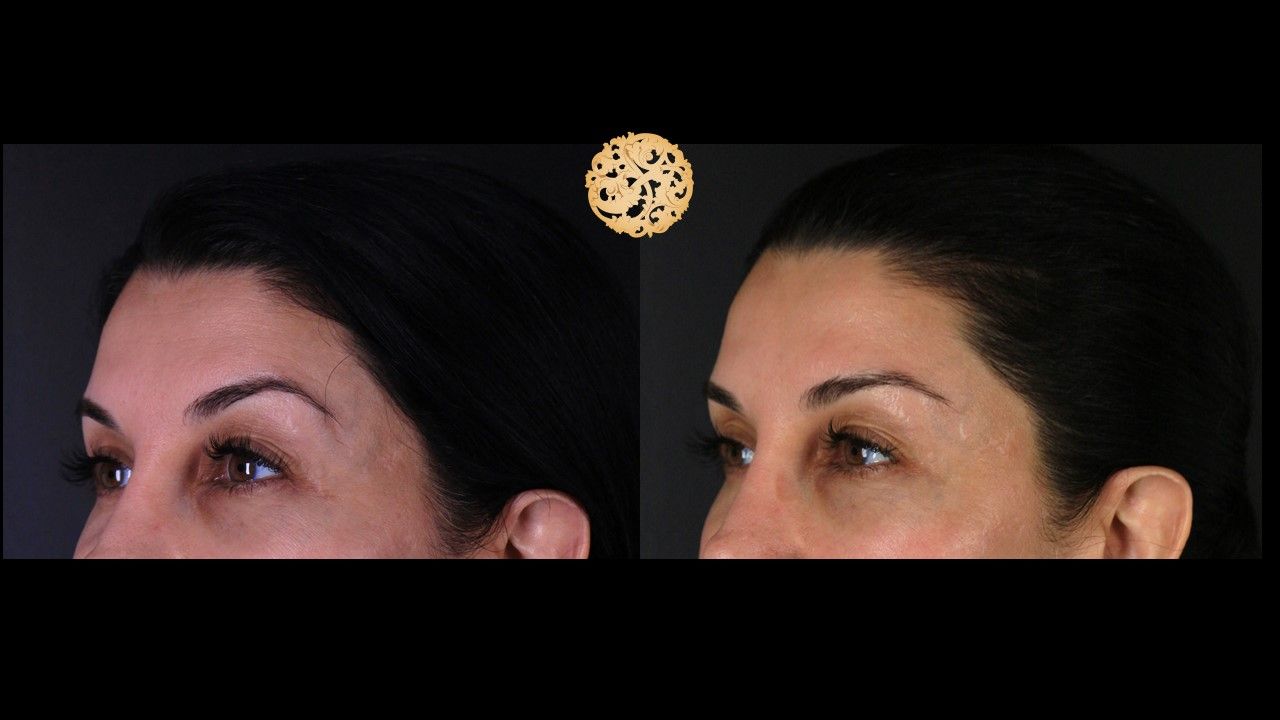 Temple Fillers Before & After