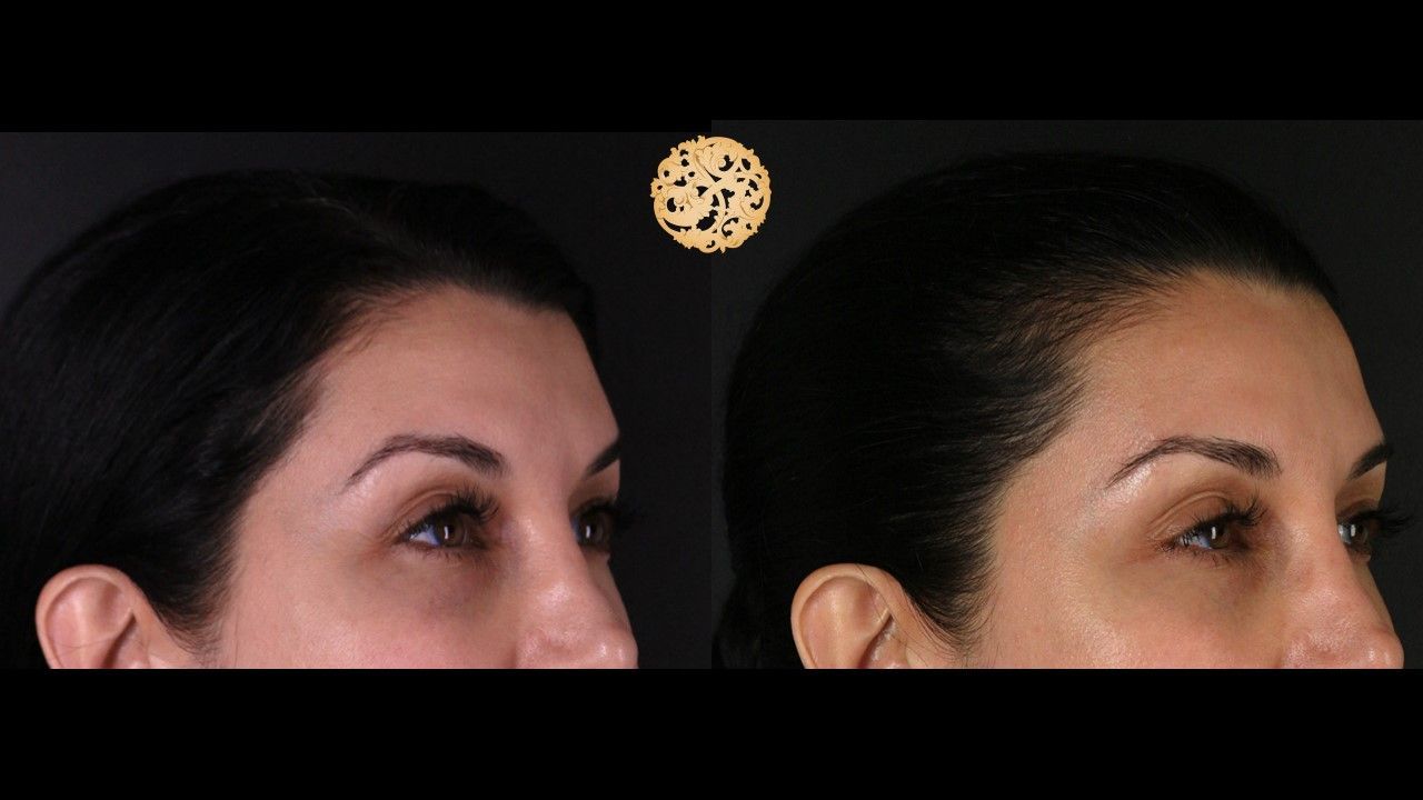 Temple Fillers Before & After