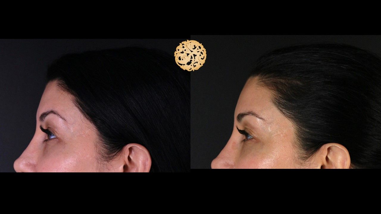 Temple Fillers Before & After