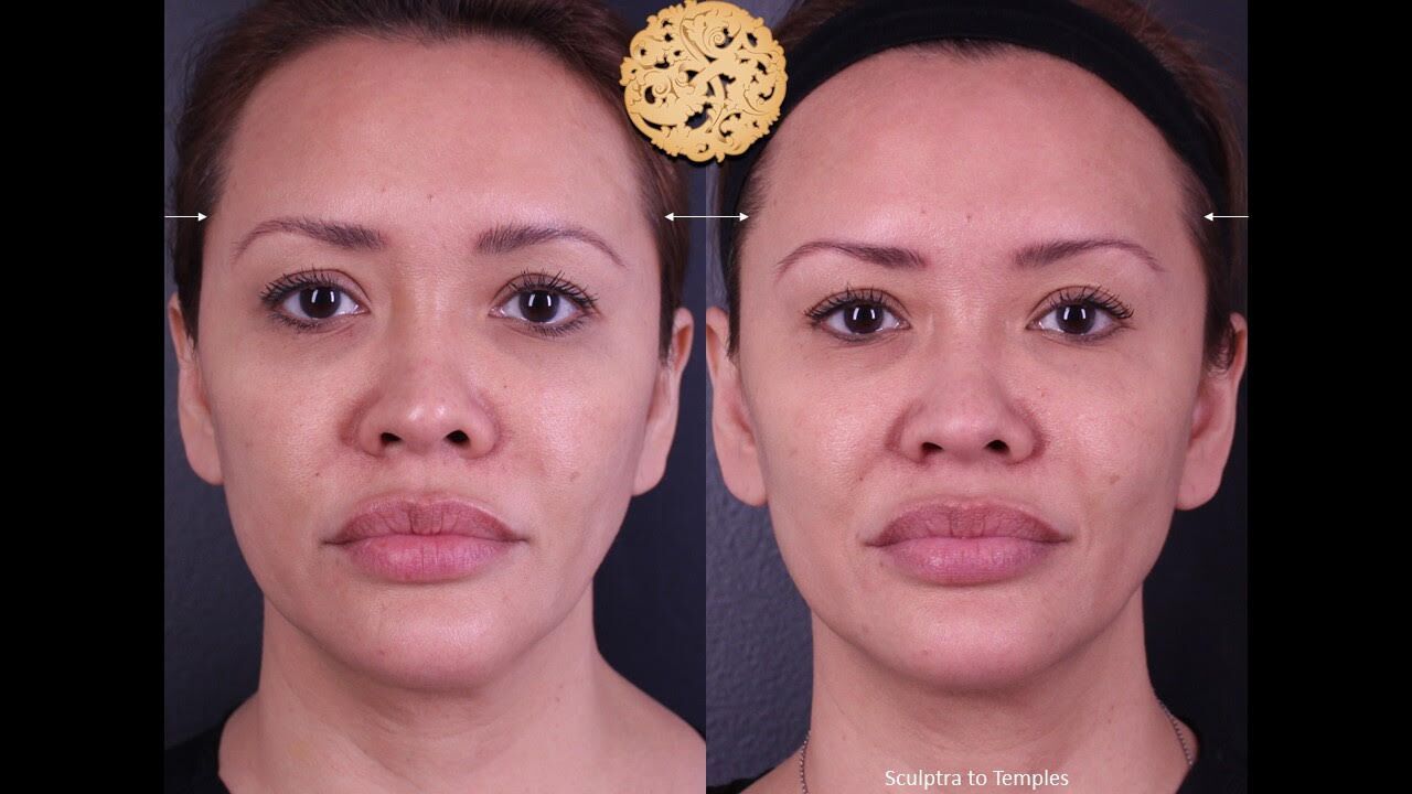 Temple Fillers Before & After