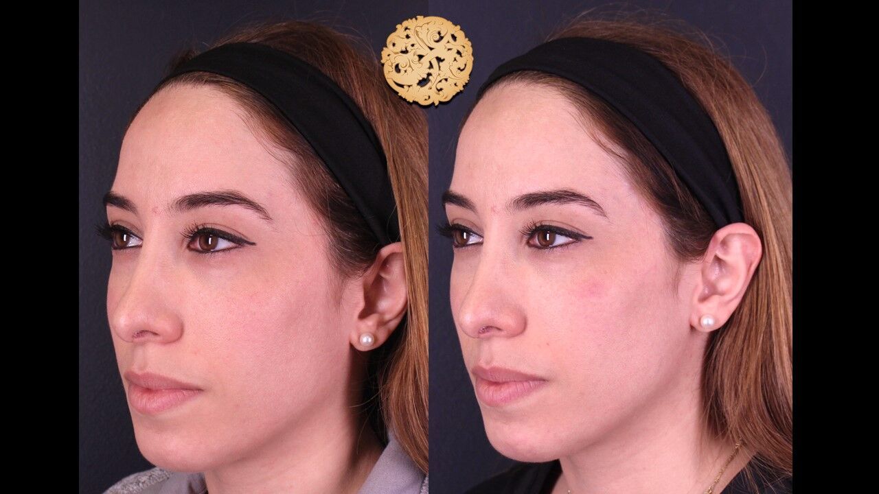 Temple Fillers Before & After