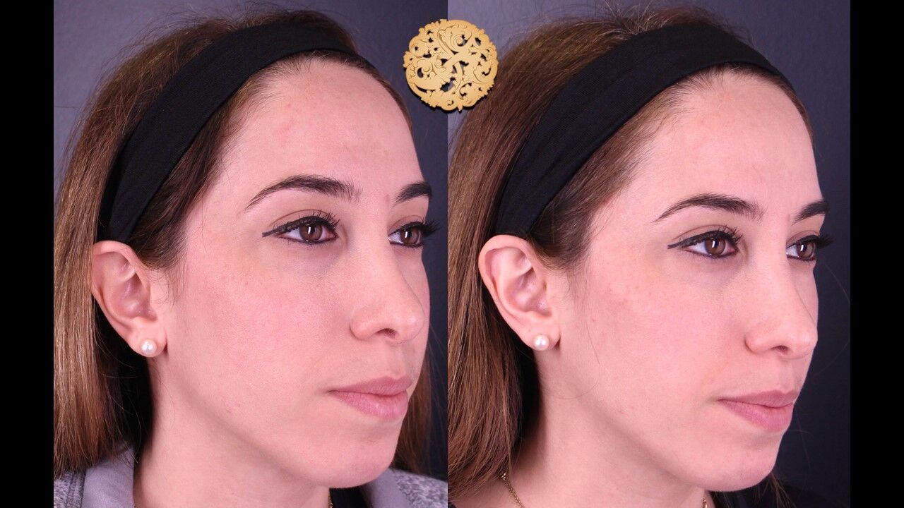 Temple Fillers Before & After