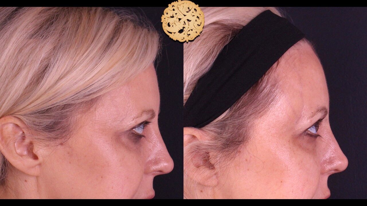 Temple Fillers Before & After