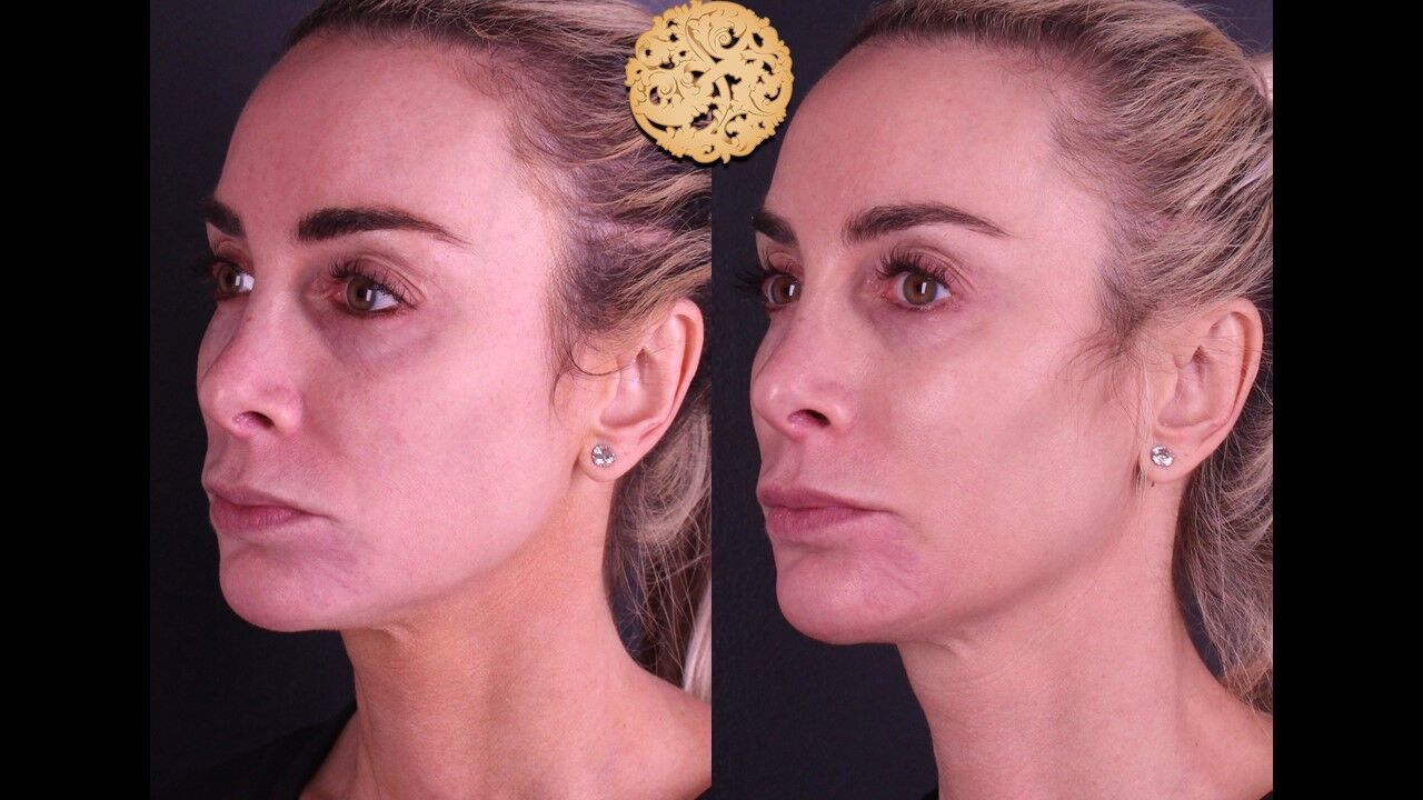 Temple Fillers Before & After