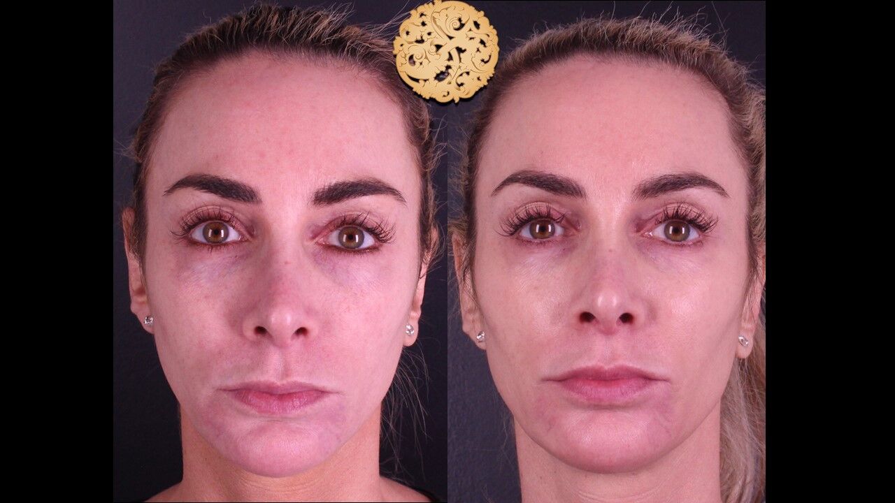Temple Fillers Before & After