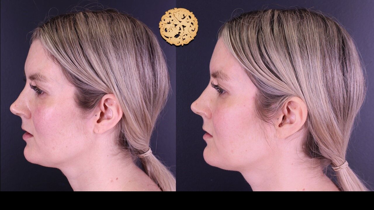 Temple Fillers Before & After