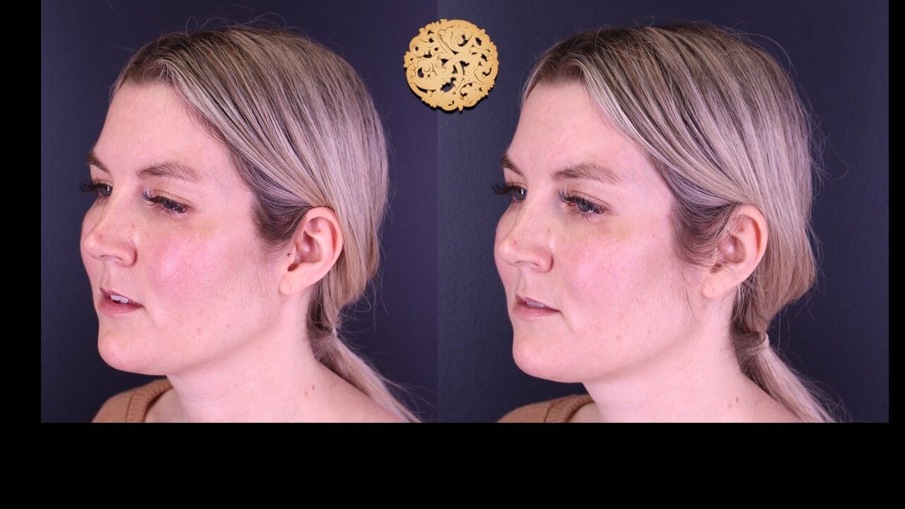 Temple Fillers Before & After