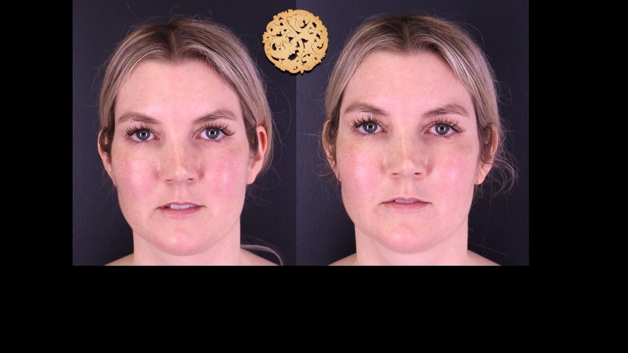 Temple Fillers Before & After