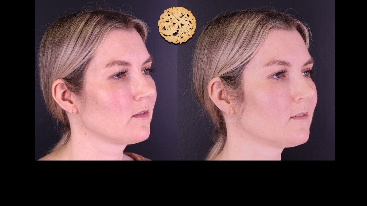 Temple Fillers Before & After