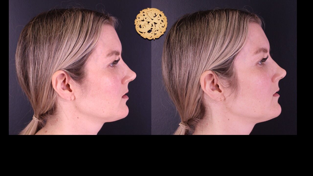 Temple Fillers Before & After