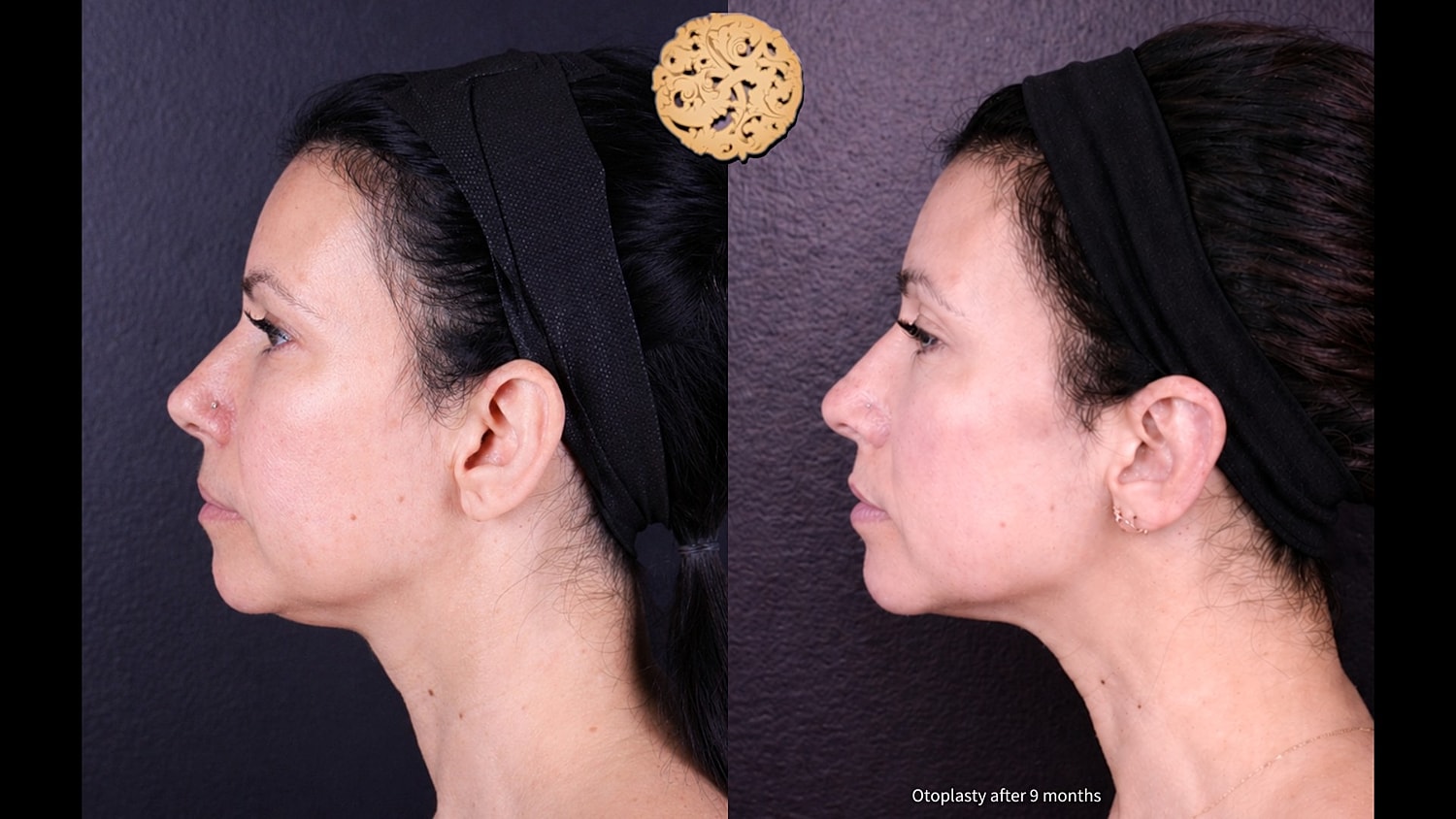 Otoplasty before and after side profile comparison.