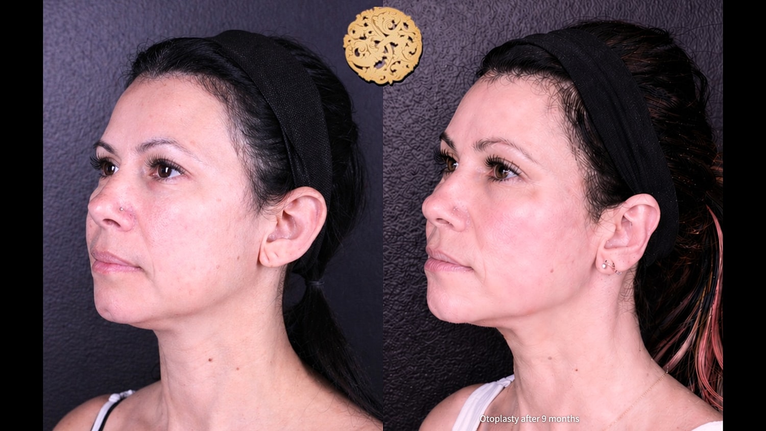 Before and after otoplasty comparison images.