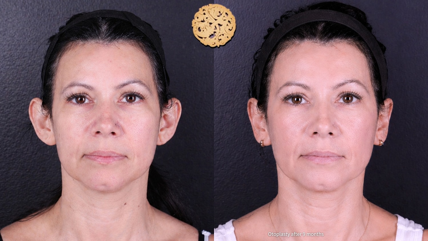 Before and after otoplasty results comparison.
