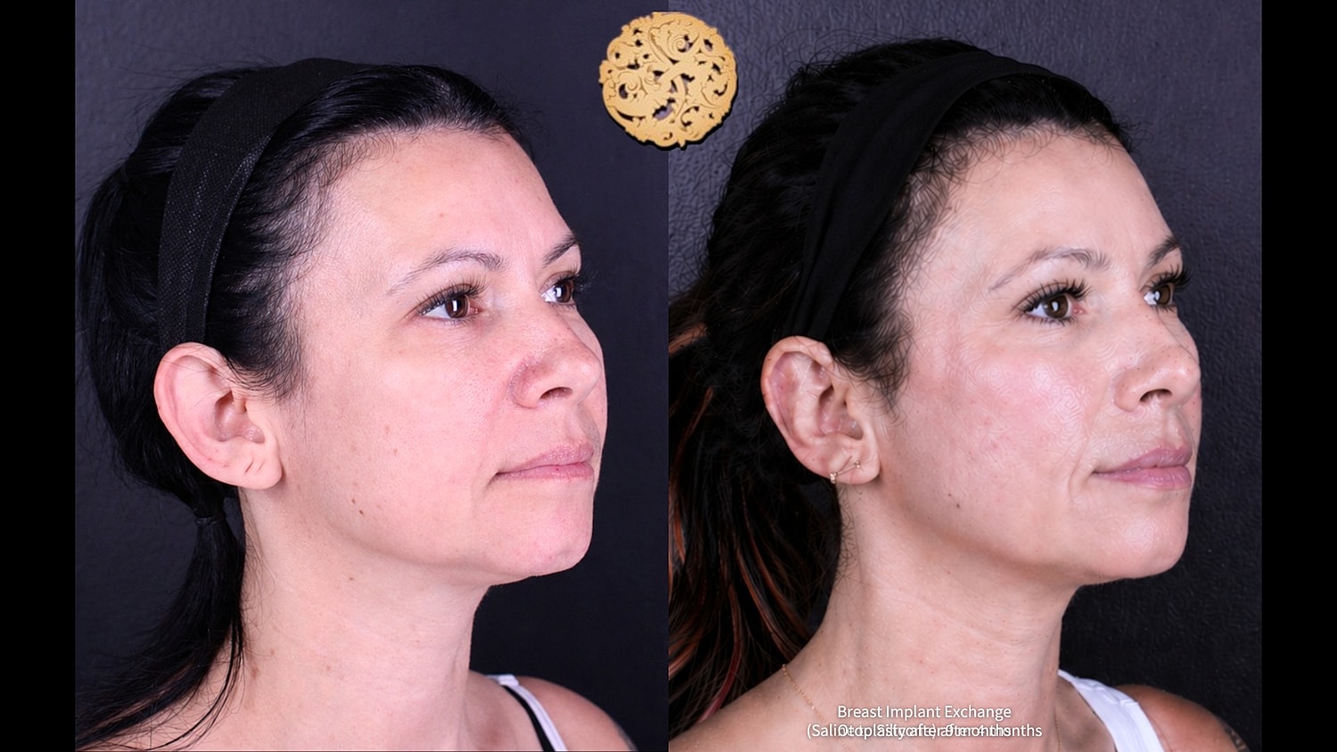 Before and after facial transformation comparison.