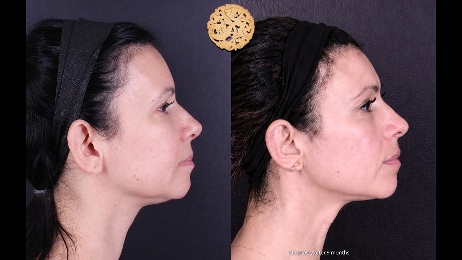 Otoplasty results: before and after comparison.