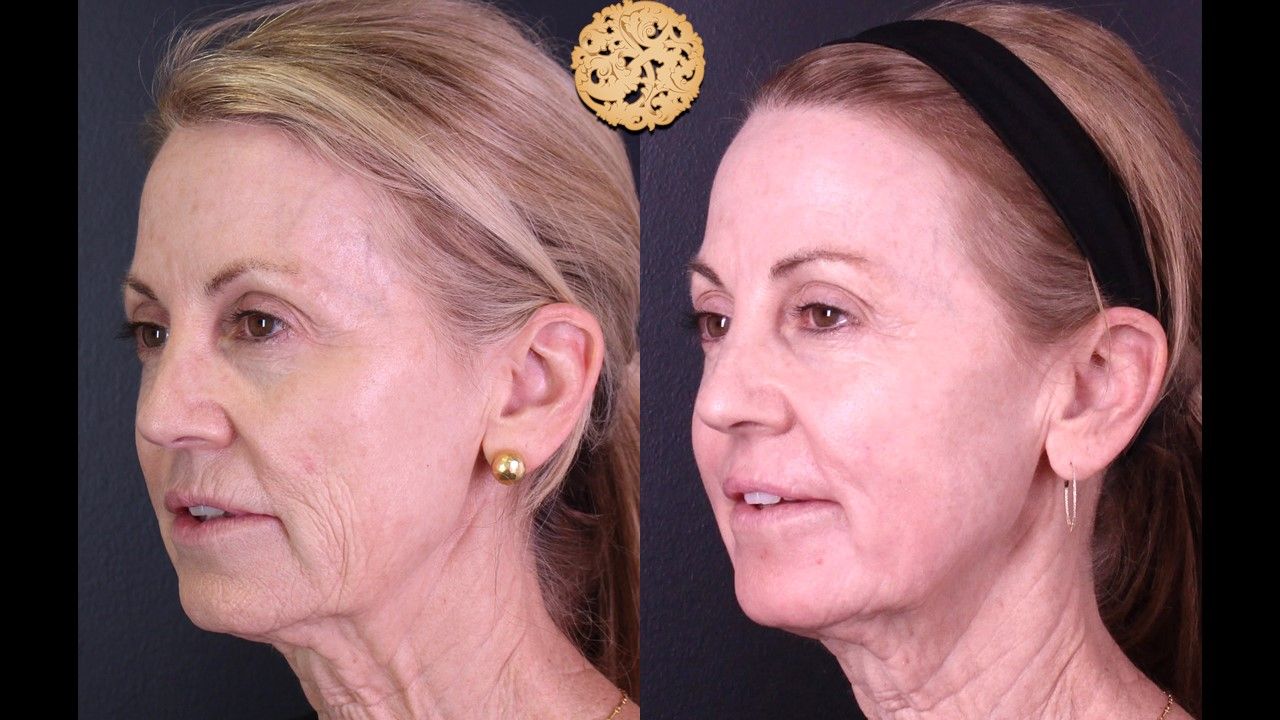 Liquid Facelift Before & After
