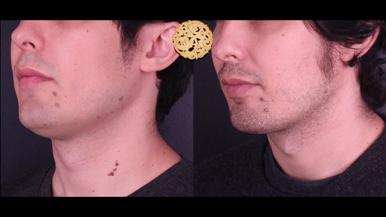 Male Chin Liposuction Before & After
