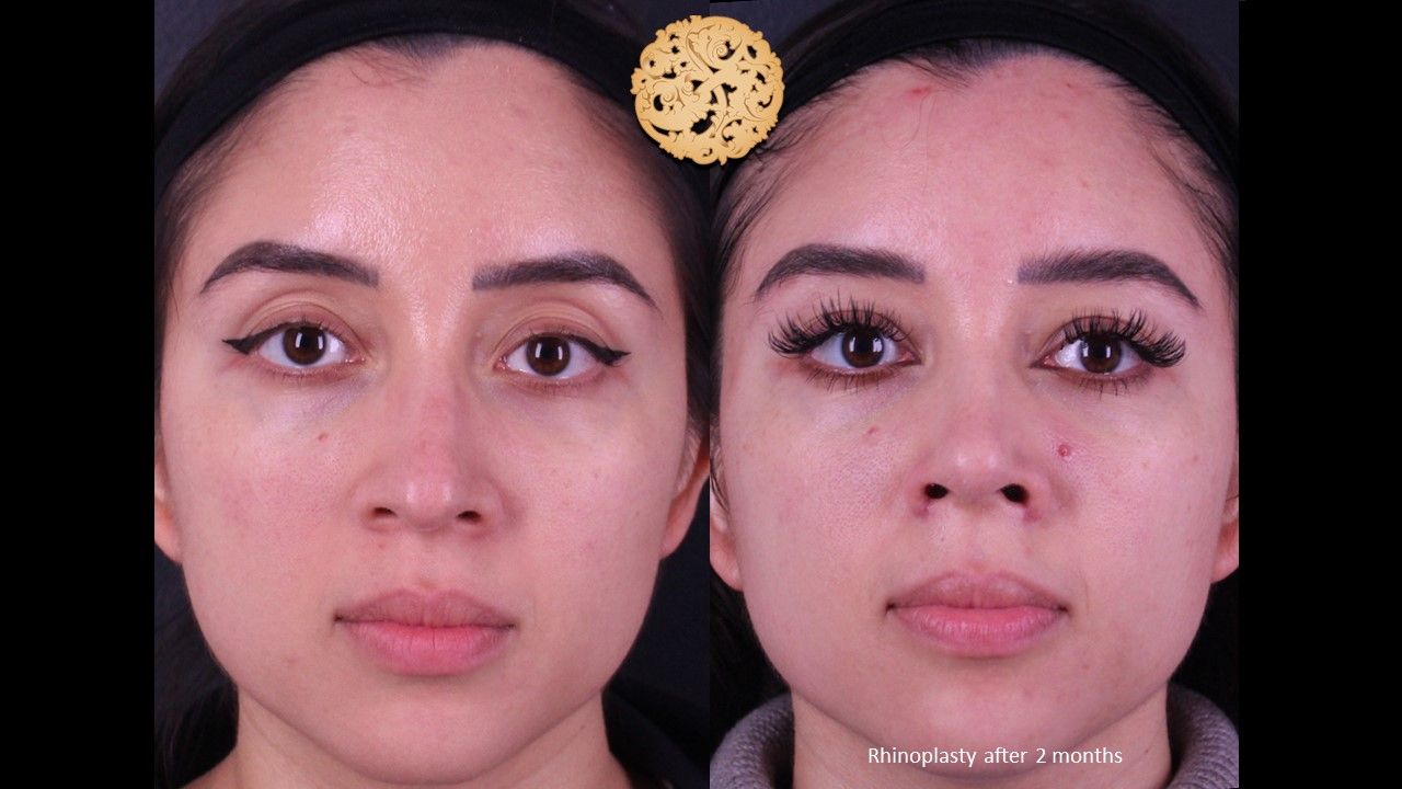 Rhinoplasty Before & After